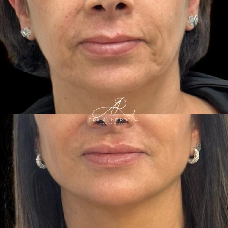harmonização facial